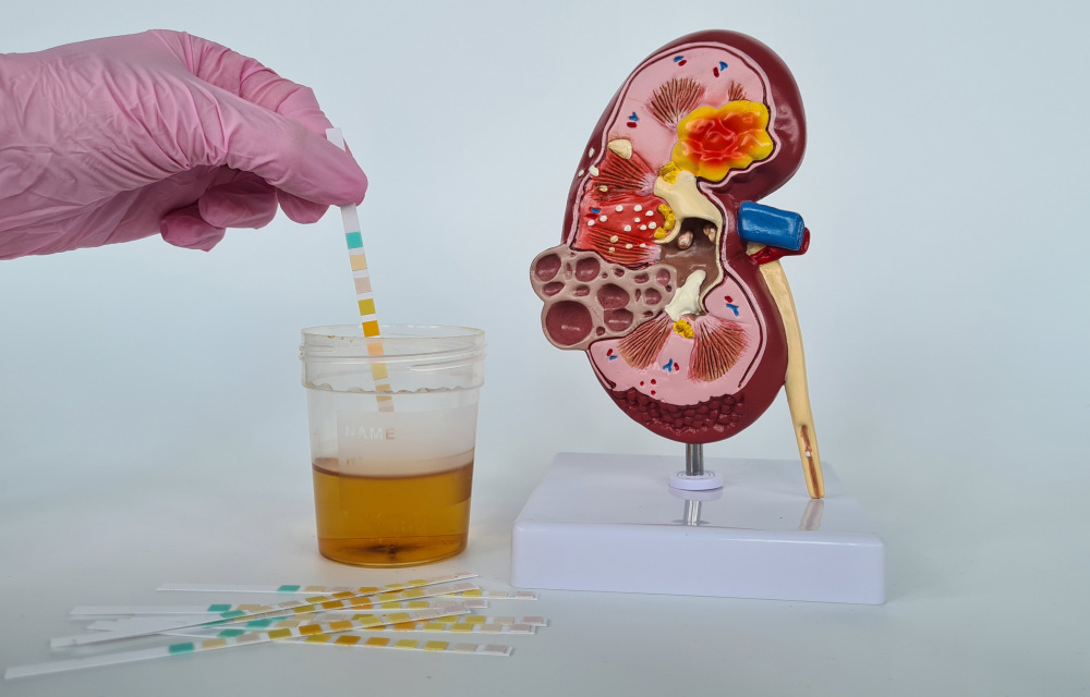 Цистит: симптомы и лечение_4